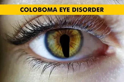 Coloboma Eye Disorder: Types, Symptoms, Causes & Diagnosis