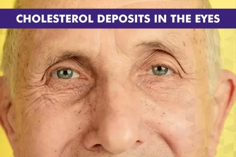 Cholesterol Deposits on Eyes (Xanthelasma): Causes & Treatment