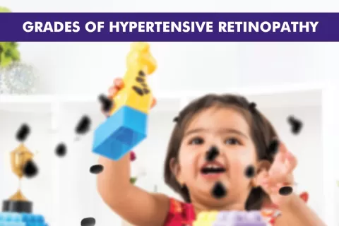 Hypertensive Retinopathy Stages: A Complete Guide