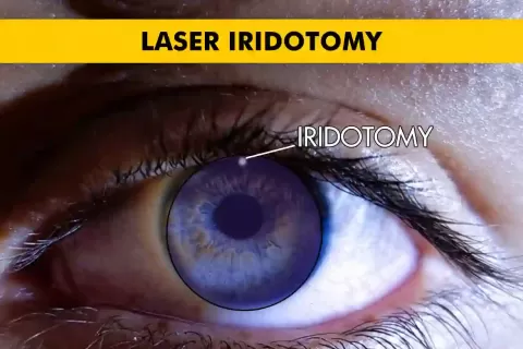 Laser Iridotomy: Frequently Asked Questions