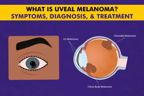 What Is Uveal Melanoma? Symptoms, Diagnosis, and Treatment
