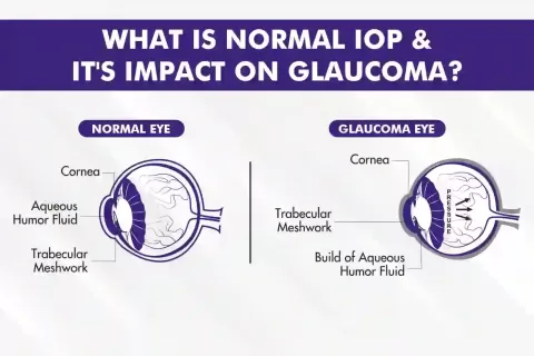What Is Normal Eye Pressure? IOP Ranges, Risks & How to Protect