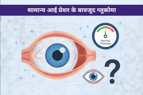 नॉर्मल टेंशन ग्लूकोमा (NTG): सामान्य आई प्रेशर के बावजूद ग्लूकोमा