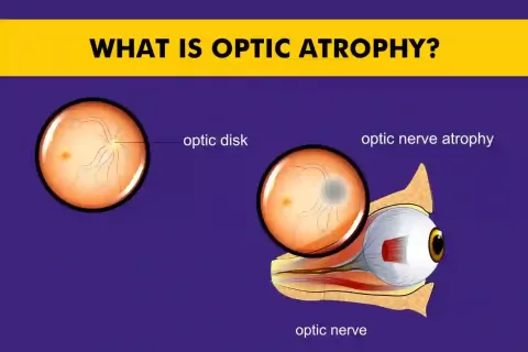 Optic Atrophy Treatment: Causes, Symptoms, and Management