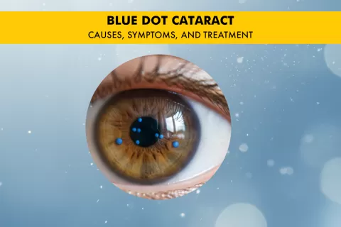 Blue Dot Cataract: Causes, Symptoms, and Treatment