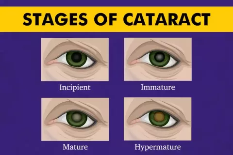 Cataract Grading - Types, Chart & Classification Explained