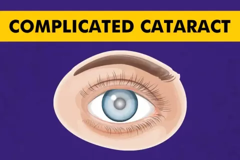 Complicated Cataract: Causes, Symptoms, and Treatment