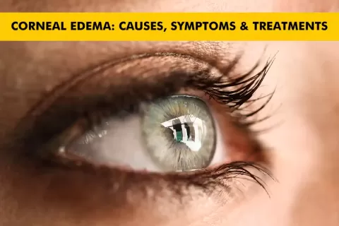 Corneal Edema Explained: Signs, Risks & Care Options