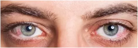 Could Fasting Cause Dry Eyes?
