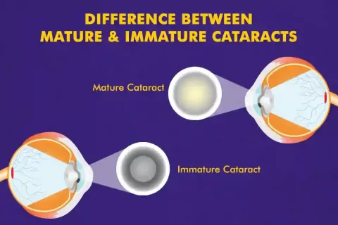 Mature vs Immature Cataract ? Understanding the Differences