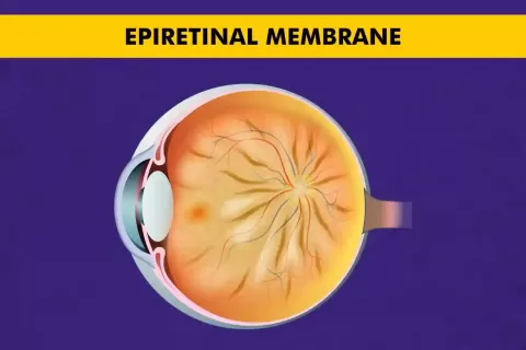 Epiretinal Membrane (ERM): Symptoms, Causes, and Treatment
