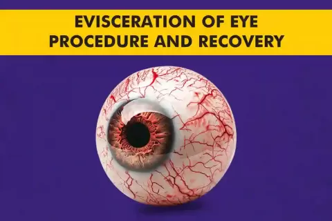 Evisceration of the Eye: Procedure, Indications & Recovery