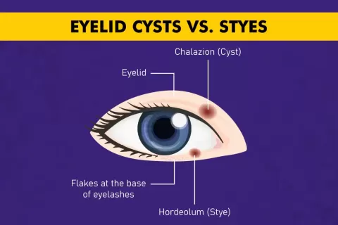 Difference Between Eyelid Cysts vs. Styes
