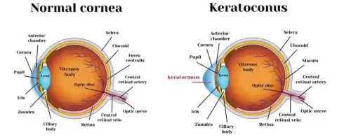 What is Corneal Disease: Symptoms, Facts &amp; More