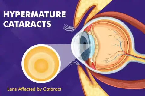 Hypermature Cataracts: Causes, Types, Symptoms, and Treatments