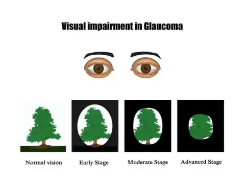 Glaucoma Symptoms: Early Signs, Risks, Prevention