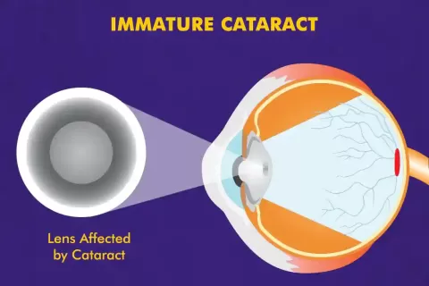 Immature Cataract ? Causes, Symptoms, Stages, and Treatment Options