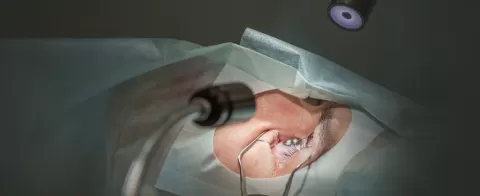 LASIK Eye Surgery Process