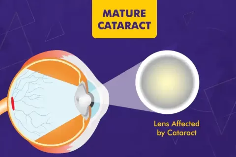Mature Cataract ? Understanding Its Causes, Symptoms, and Treatment