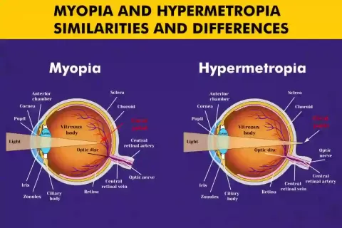 Myopia vs Hypermetropia: Difference, Symptoms & Treatment Options
