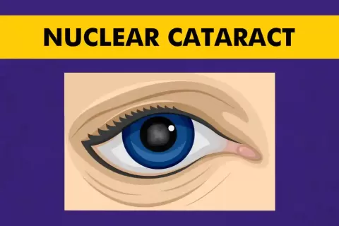 Nuclear Cataract Symptoms, Causes, and Treatment Options