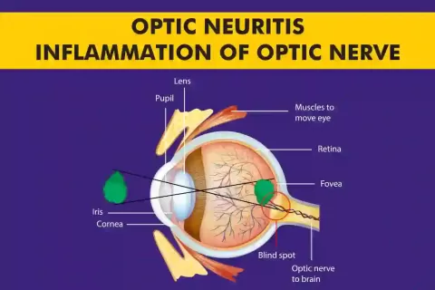 Optic Neuritis ? Inflammation of Optic Nerve