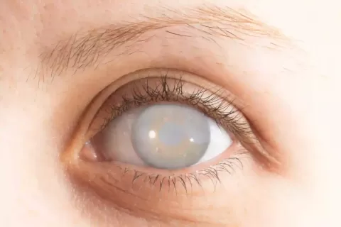 Posterior Capsular Opacification (PCO): Causes, Diagnosis & Cure