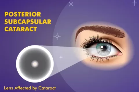Posterior Subcapsular Cataract: Causes and Possible Treatment