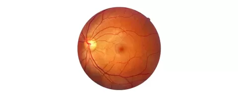 Retinal Detachment Causes, Symptoms &amp; Treatment