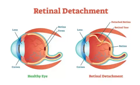 Retinal Detachment: Symptoms & Emergency Treatment