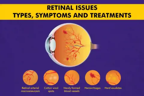 Retinal Diseases - Types, Symptoms and Treatments