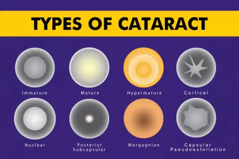 Types of Cataracts: Symptoms, Causes, Stages and Treatment