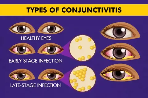 Types of Conjunctivitis and How They Affect the Eyes