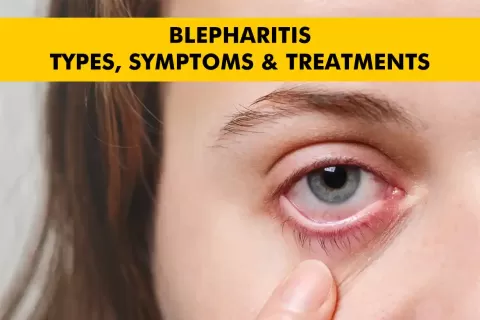 Understanding Blepharitis: Types, Symptoms, and Effective Treatments