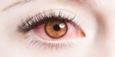 What Causes Red or Bloodshot Eyes & How to Treat Them