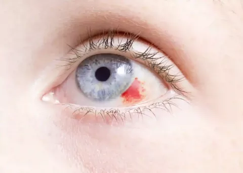 Corneal Abrasion: What It Is, Symptoms, Risks & Treatment