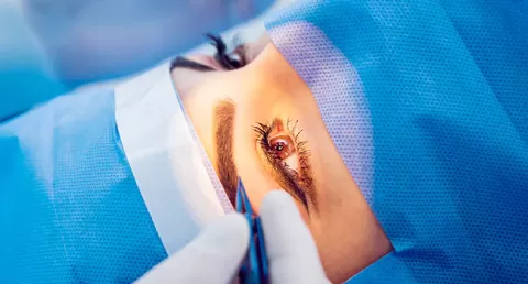 Types of Laser Eye Surgery: LASIK, PRK, SMILE, SILK & More