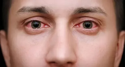 Burning Eyes: Reasons, Symptoms & Home Remedies