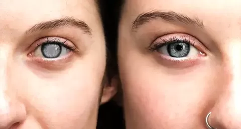 After Cataract Surgery: What to Expect Day by Day