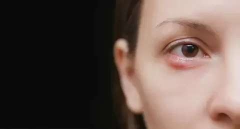 Chalazion (Eyelid Lump): Causes, Symptoms & Treatment
