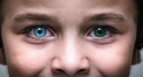 (Heterochromia) Two Different Eye Colours : Causes, Types & Diagnosis