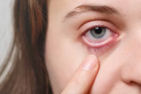 Uveitis - Definition, Symptoms, Causes, and Signs