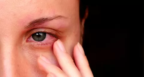 Watery Eyes (Epiphora): Causes, Home Remedies & Treatment