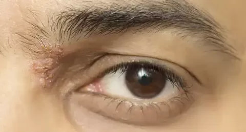 Shingles in the Eye: Symptoms, Causes, Treatment & Prevention