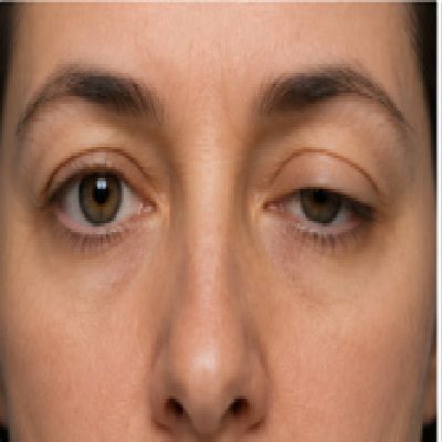 CornealTransplant