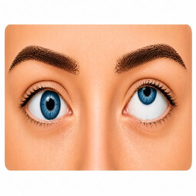 Hypertropia - Upward deviation of one eye