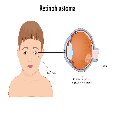 Understanding Retinoblastoma Layout View