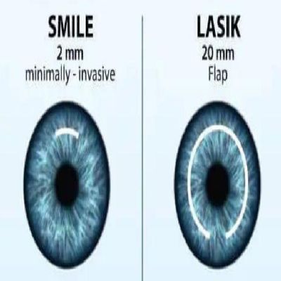 SMILE vs LASIK