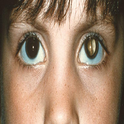 Unilateral retinoblastoma medical graphic